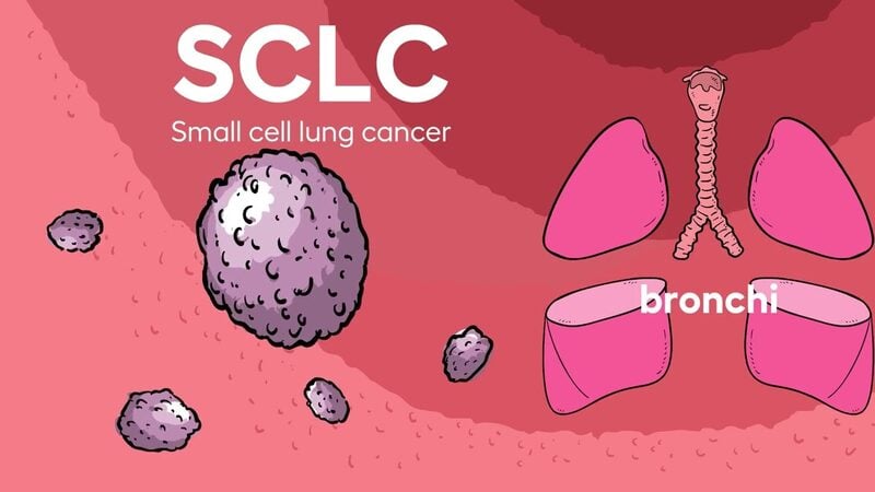 SCLC Explained: animated illustration of small cell lung cancer cells and the bronchi